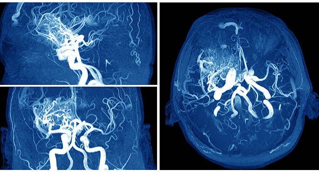 Angiograma cerebral