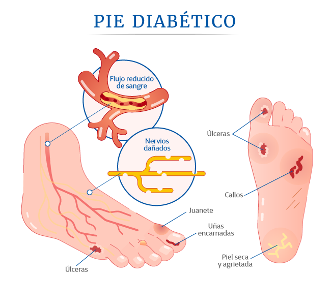 Pie del diabético y salvamento de extremidad