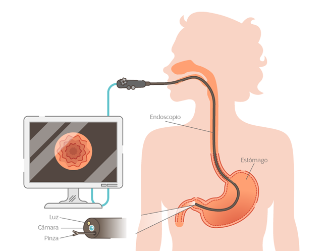 Con la endoscopia gastrointestinal se obtienen imágenes de alta resolución para diagnósticos acertados
