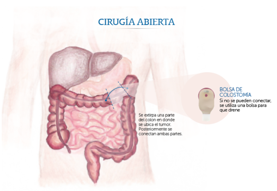 Cirug�a abierta