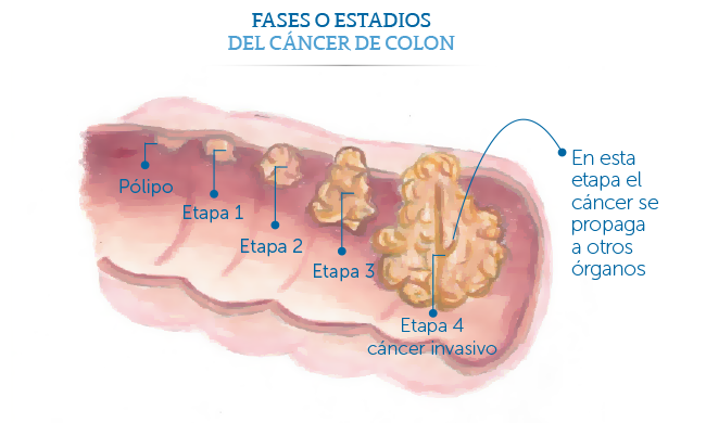 Fases de c�ncer de colon