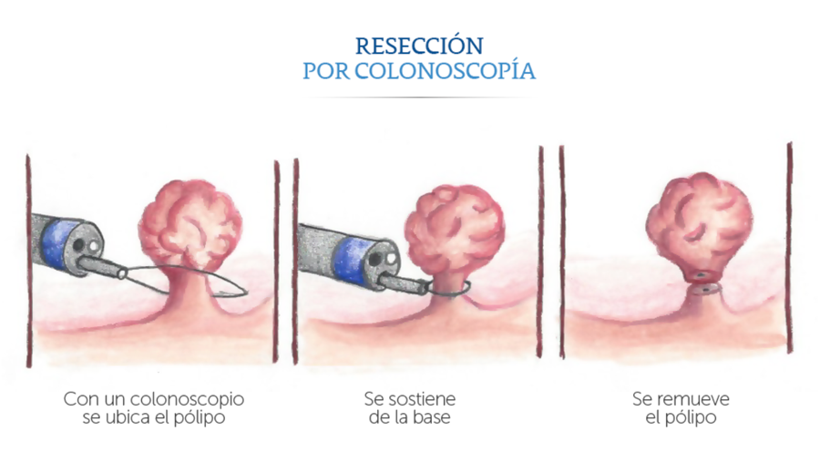 Resecci�n por colonoscop�a