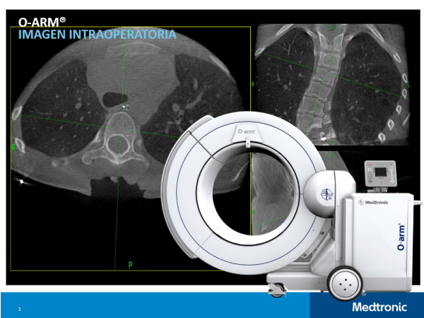 Sistema O-arm, visualizaci�n de cirug�as de la columna vertebral en tiempo real