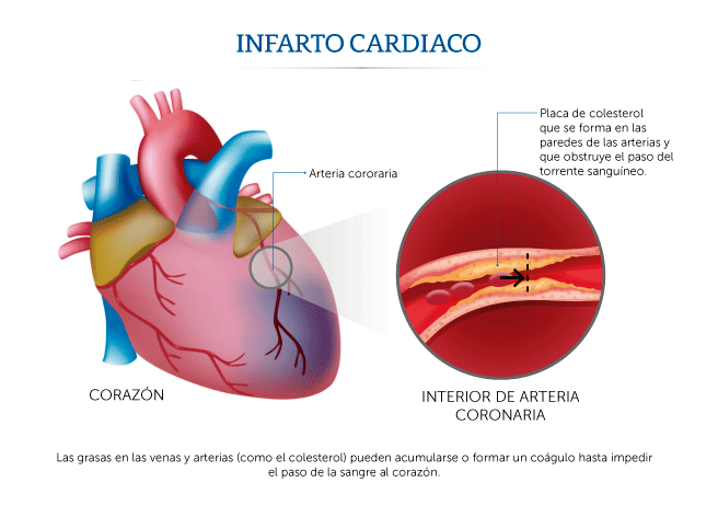 Ilustraci�n sobre c�mo ocurre un infarto cardiaco